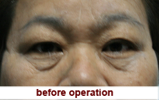 plastic-surgery-blepharoplasty